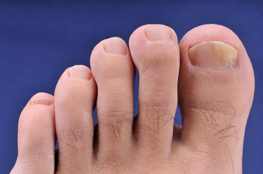 תסמינים של פטריה ציפורניים על הרגליים, המאפיינים והזנים